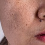 theordinary pigmentation