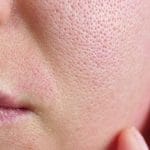 textural irregularities skin theordinary