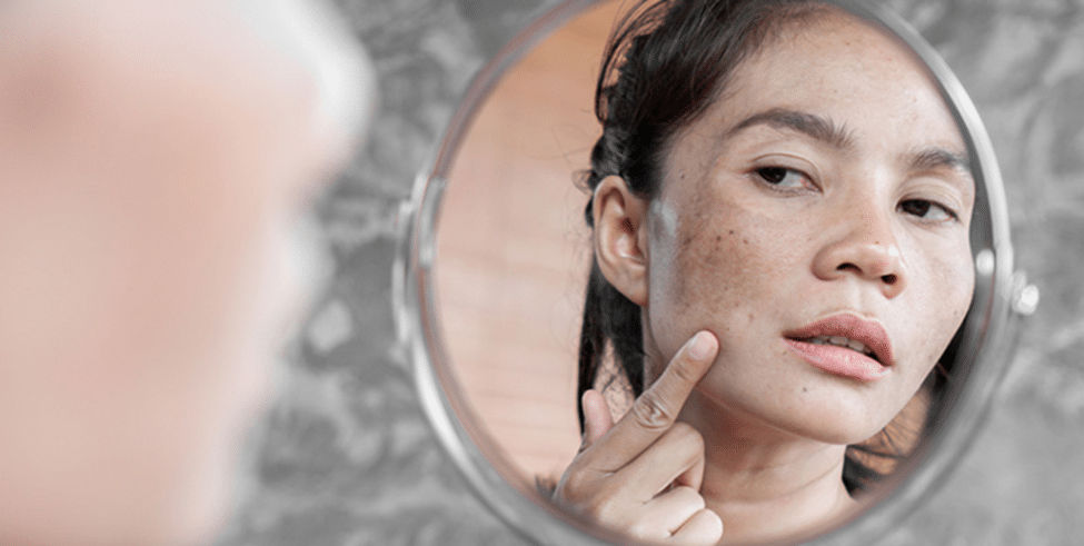 melasma-treatment-pakistan-the-ordinary.jpg Melasma treatment routine in Pakistan using The Ordinary products